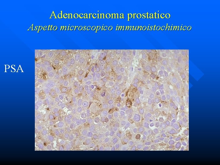 Adenocarcinoma prostatico Aspetto microscopico immunoistochimico PSA 