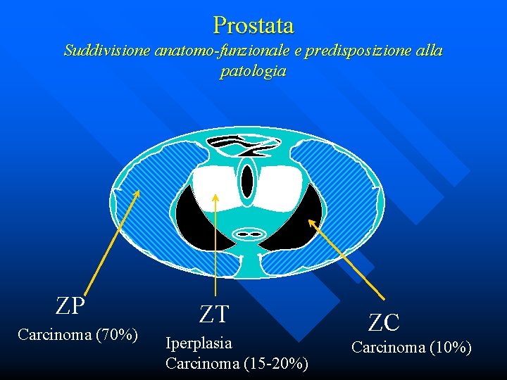 iperplasia adenomatosa atipica prostata