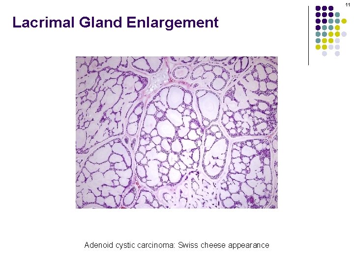 11 Lacrimal Gland Enlargement Adenoid cystic carcinoma: Swiss cheese appearance 