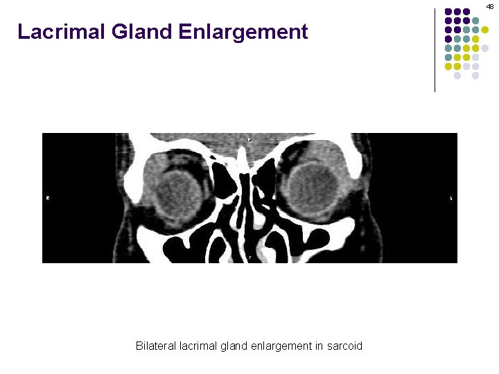 48 Lacrimal Gland Enlargement Bilateral lacrimal gland enlargement in sarcoid 