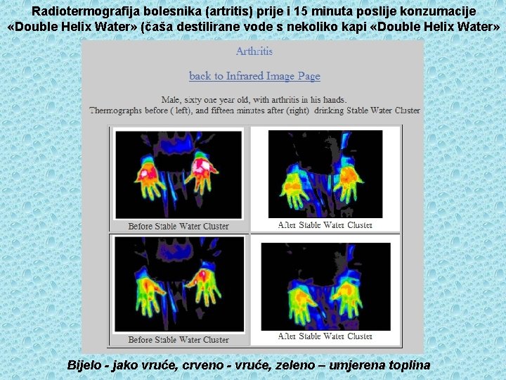 Radiotermografija bolesnika (artritis) prije i 15 minuta poslije konzumacije «Double Helix Water» (čaša destilirane