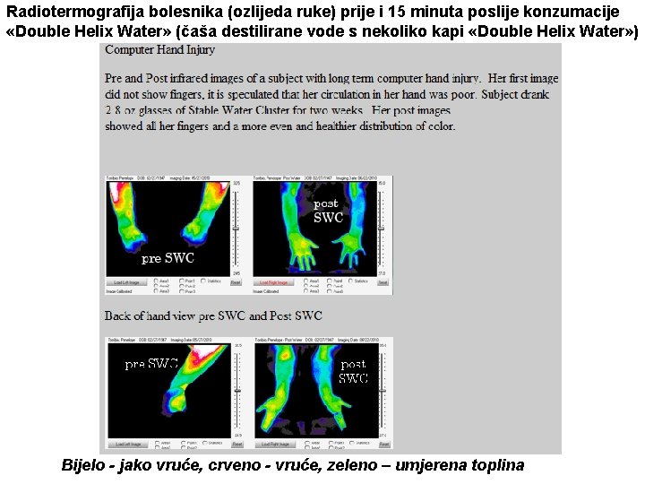 Radiotermografija bolesnika (ozlijeda ruke) prije i 15 minuta poslije konzumacije «Double Helix Water» (čaša