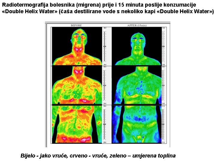 Radiotermografija bolesnika (migrena) prije i 15 minuta poslije konzumacije «Double Helix Water» (čaša destilirane