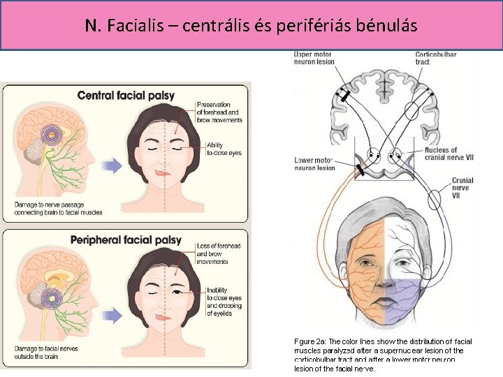 N. Facialis – centrális és perifériás bénulás 
