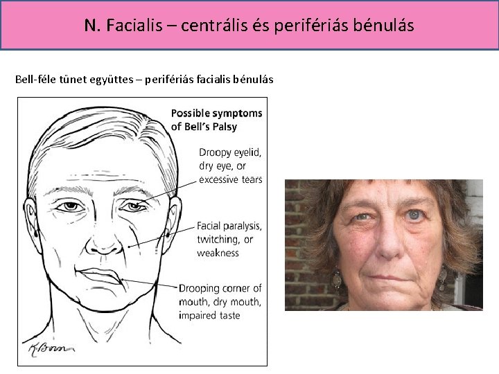N. Facialis – centrális és perifériás bénulás Bell-féle tünet együttes – perifériás facialis bénulás