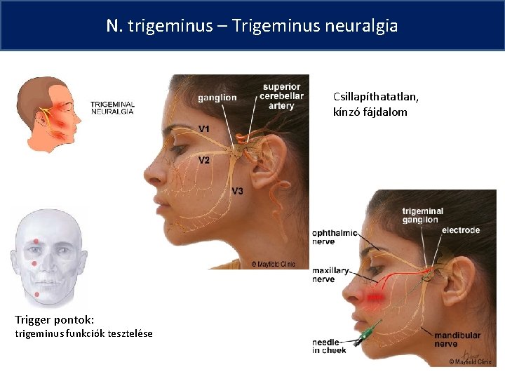 N. trigeminus – Trigeminus neuralgia Csillapíthatatlan, kínzó fájdalom Trigger pontok: trigeminus funkciók tesztelése 