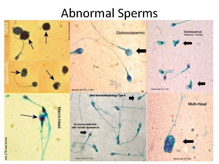 Abnormal Sperms 