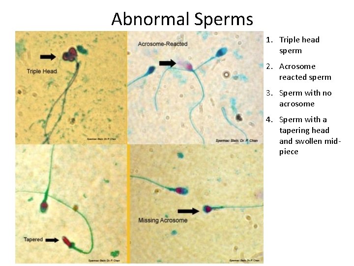 Abnormal Sperms 1. Triple head sperm 2. Acrosome reacted sperm 3. Sperm with no