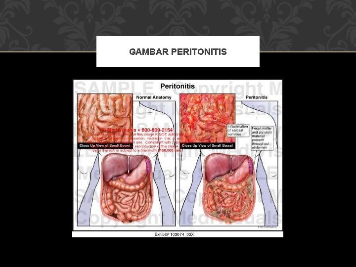 GAMBAR PERITONITIS 