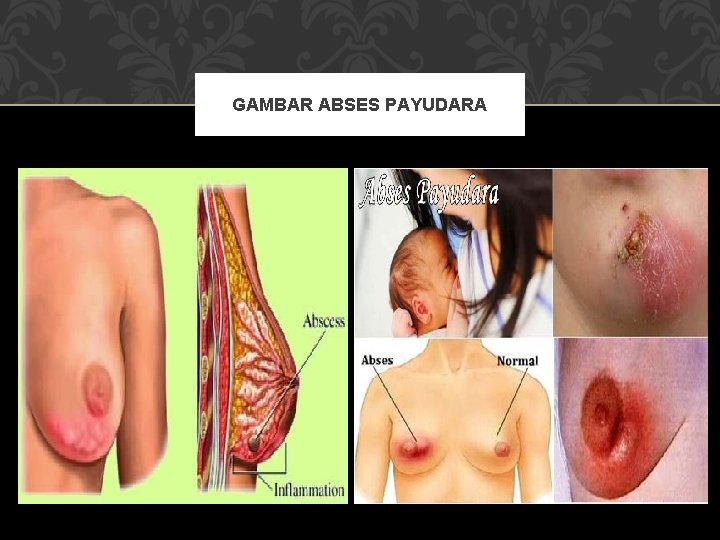 GAMBAR ABSES PAYUDARA 