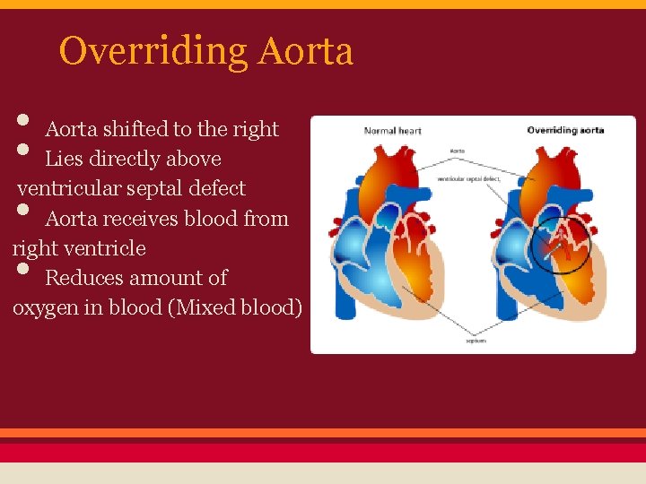 Overriding Aorta • Aorta shifted to the right • Lies directly above ventricular septal