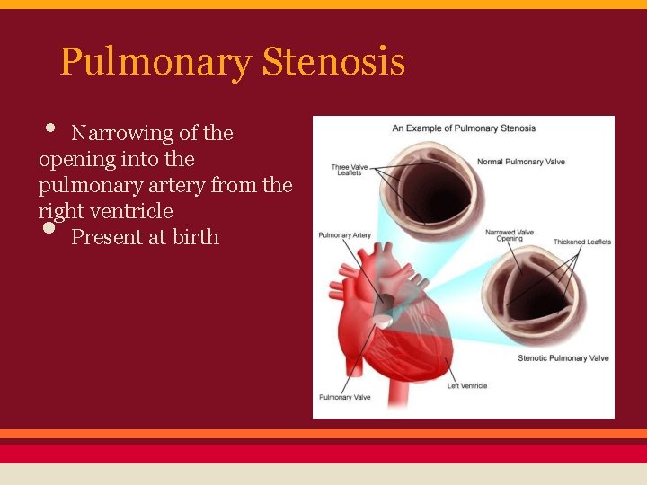 Pulmonary Stenosis • Narrowing of the opening into the pulmonary artery from the right