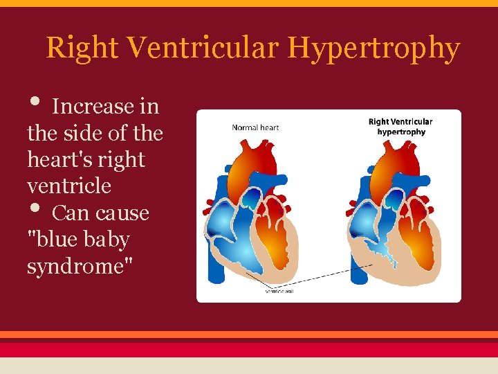 Right Ventricular Hypertrophy • Increase in the side of the heart's right ventricle Can
