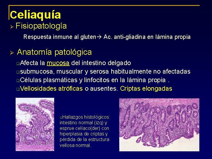 Celiaquía Ø Fisiopatología Respuesta inmune al gluten Ac. anti-gliadina en lámina propia Ø Anatomía