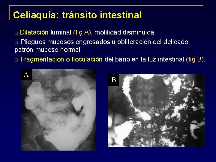 Celiaquía: tránsito intestinal Dilatación luminal (fig A), motilidad disminuida q Pliegues mucosos engrosados u