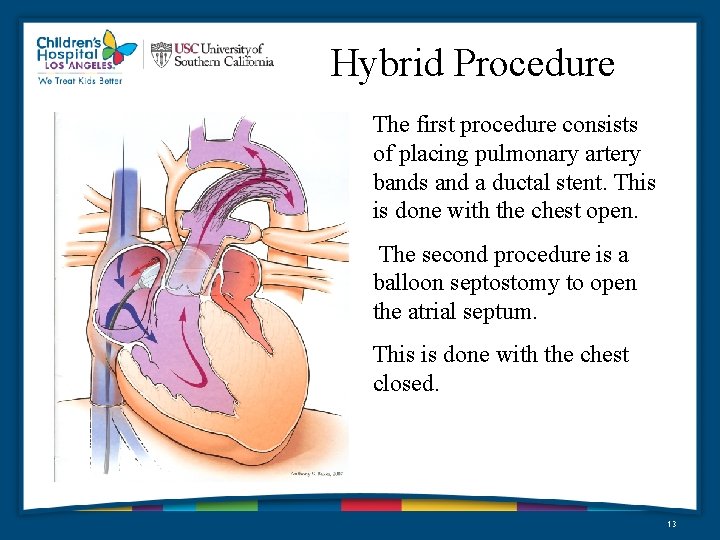 Hybrid Procedure The first procedure consists of placing pulmonary artery bands and a ductal