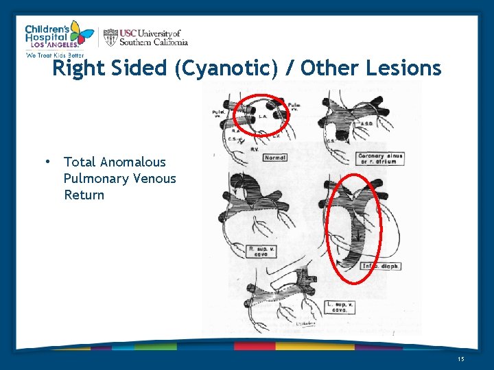 Right Sided (Cyanotic) / Other Lesions • Total Anomalous Pulmonary Venous Return 15 