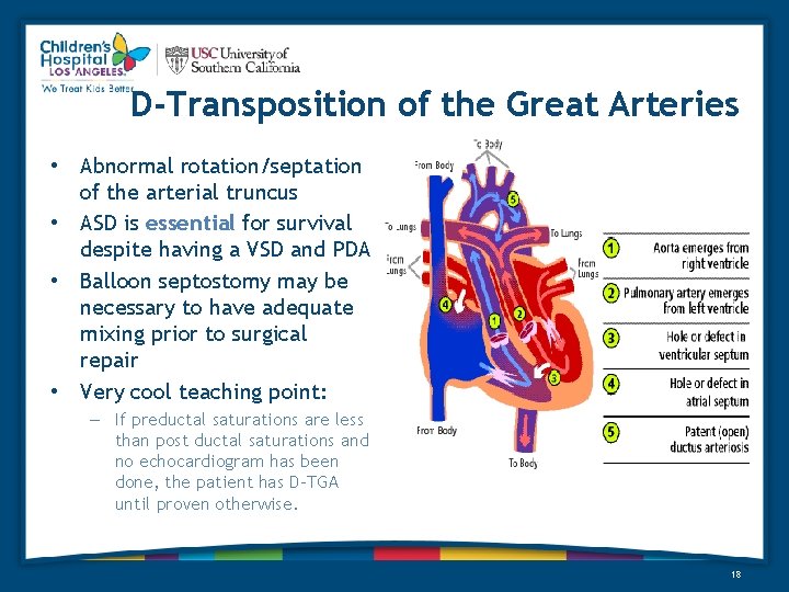 D-Transposition of the Great Arteries • Abnormal rotation/septation of the arterial truncus • ASD