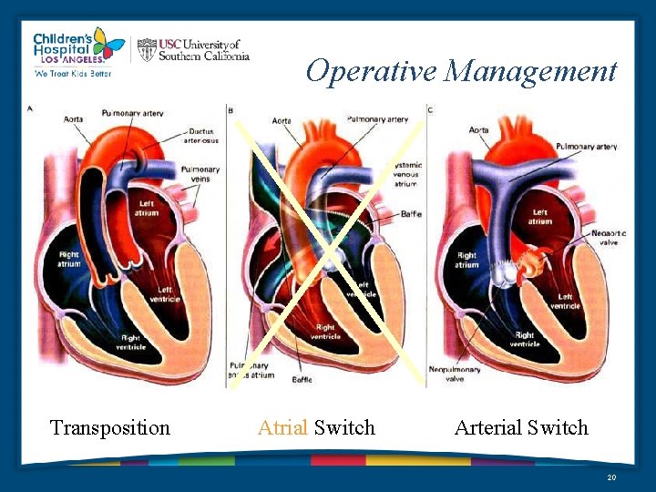 Operative Management Transposition Atrial Switch Arterial Switch 20 