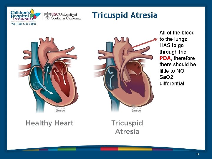 Tricuspid Atresia All of the blood to the lungs HAS to go through the