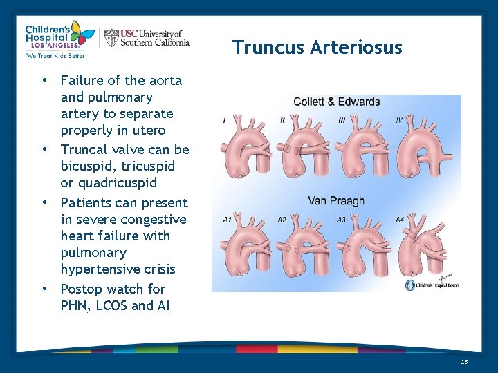 Truncus Arteriosus • Failure of the aorta and pulmonary artery to separate properly in