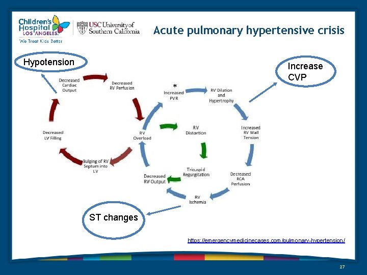 Acute pulmonary hypertensive crisis Hypotension Increase CVP ST changes https: //emergencymedicinecases. com/pulmonary-hypertension/ 27 