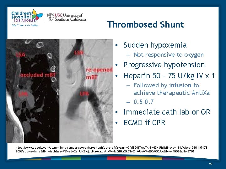 Thrombosed Shunt • Sudden hypoxemia – Not responsive to oxygen • Progressive hypotension •