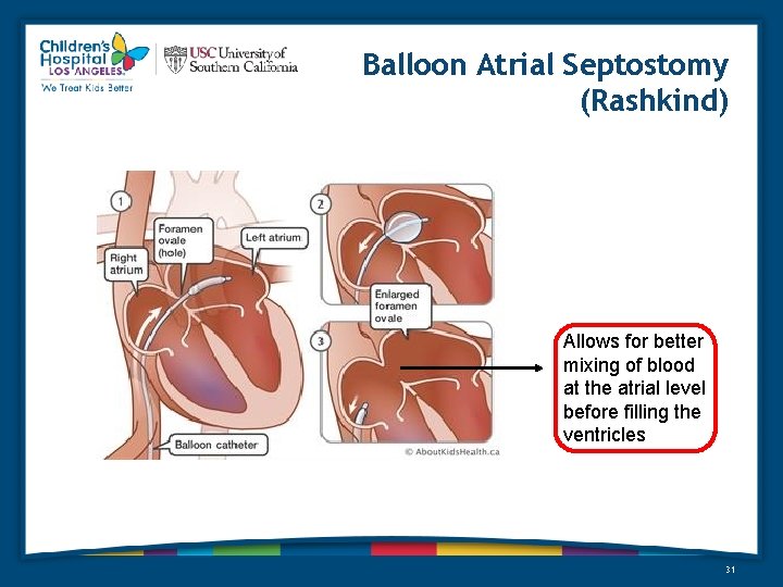 Balloon Atrial Septostomy (Rashkind) Allows for better mixing of blood at the atrial level
