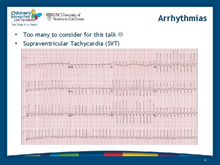 Arrhythmias • Too many to consider for this talk • Supraventricular Tachycardia (SVT) 32