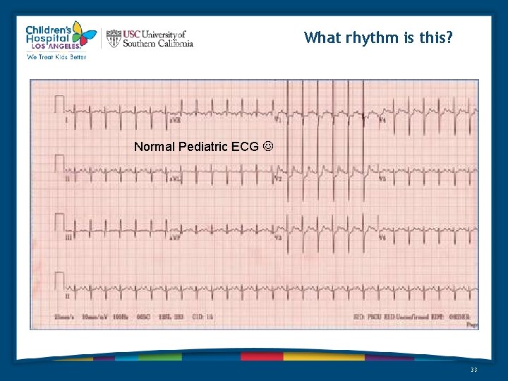 What rhythm is this? Normal Pediatric ECG 33 