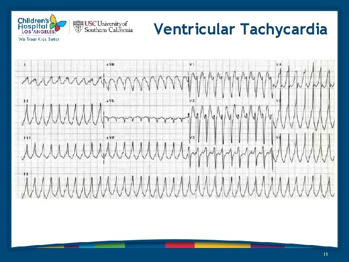 Ventricular Tachycardia 35 