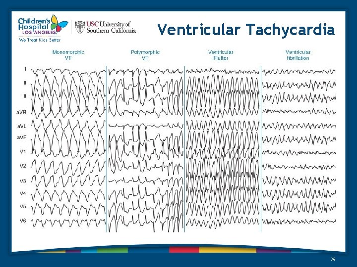 Ventricular Tachycardia 36 