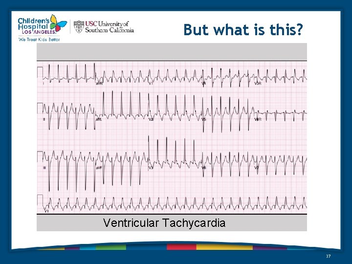 But what is this? Ventricular Tachycardia 37 