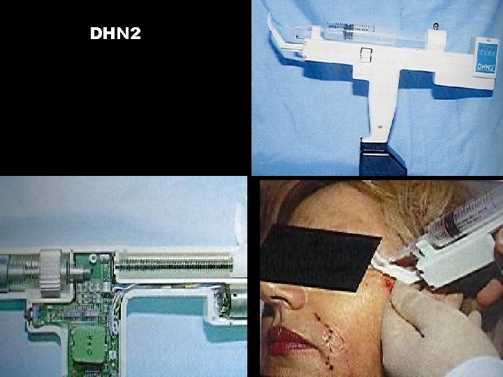DHN 2 DHN 2