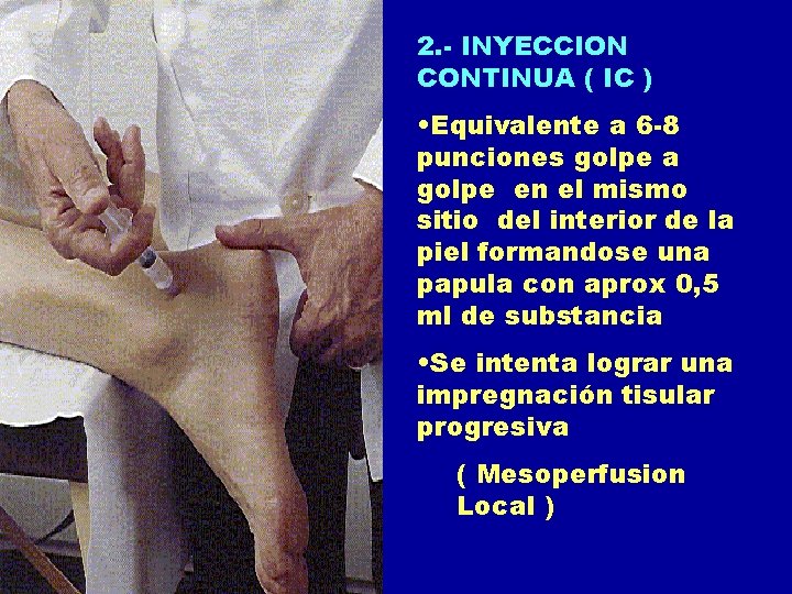 2. - INYECCION CONTINUA ( IC ) • Equivalente a 6 -8 punciones golpe 2. - INYECCION CONTINUA ( IC ) • Equivalente a 6 -8 punciones golpe