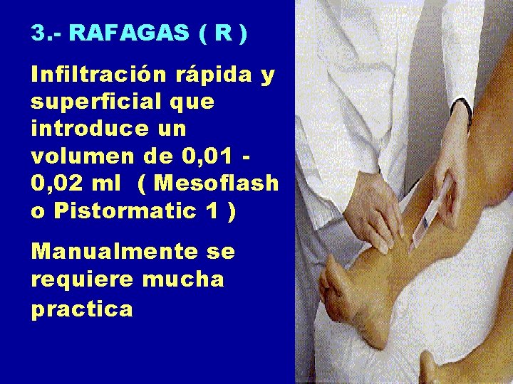 3. - RAFAGAS ( R ) Infiltración rápida y superficial que introduce un volumen 3. - RAFAGAS ( R ) Infiltración rápida y superficial que introduce un volumen