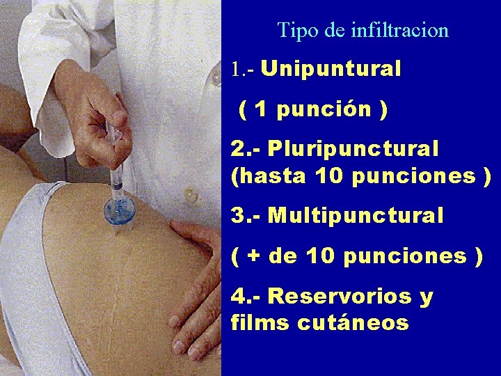 Tipo de infiltracion 1. - Unipuntural ( 1 punción ) 2. - Pluripunctural (hasta Tipo de infiltracion 1. - Unipuntural ( 1 punción ) 2. - Pluripunctural (hasta