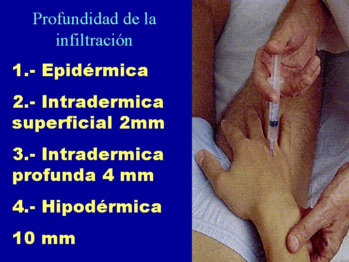 Profundidad de la infiltración 1. - Epidérmica 2. - Intradermica superficial 2 mm 3. Profundidad de la infiltración 1. - Epidérmica 2. - Intradermica superficial 2 mm 3.