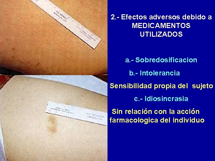 2. - Efectos adversos debido a MEDICAMENTOS UTILIZADOS a. - Sobredosificacion b. - Intolerancia 2. - Efectos adversos debido a MEDICAMENTOS UTILIZADOS a. - Sobredosificacion b. - Intolerancia