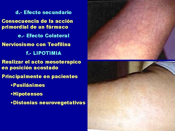 d. - Efecto secundario Consecuencia de la acción primordial de un fármaco e. - d. - Efecto secundario Consecuencia de la acción primordial de un fármaco e. -