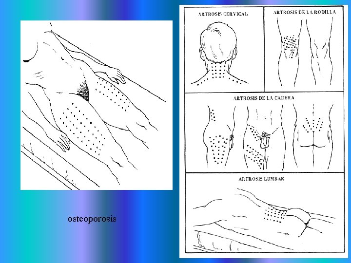 osteoporosis osteoporosis