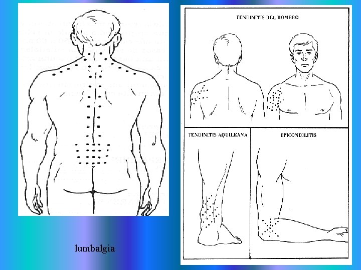 lumbalgia lumbalgia