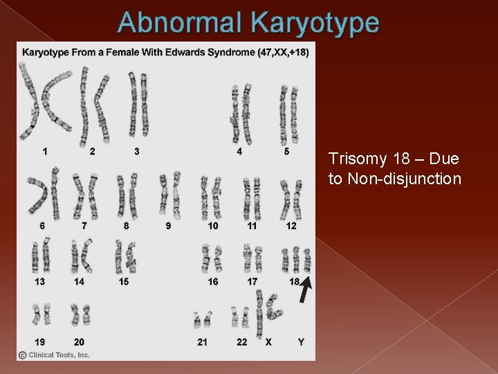 Abnormal Karyotype Trisomy 18 – Due to Non-disjunction 