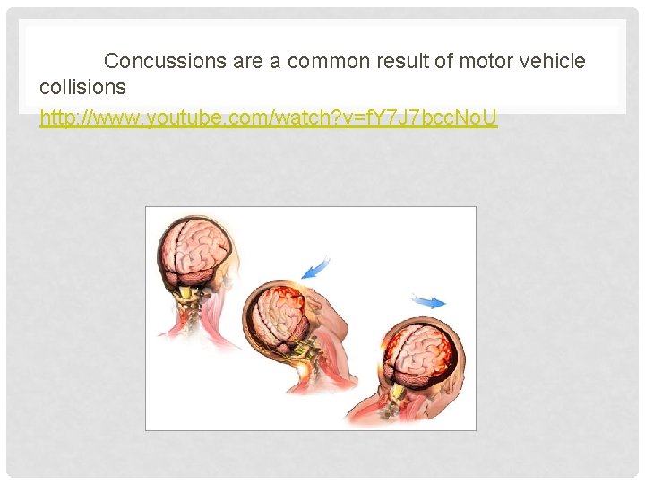 Concussions are a common result of motor vehicle collisions http: //www. youtube. com/watch? v=f.