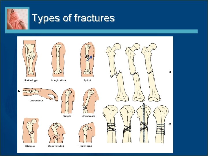 Types of fractures 