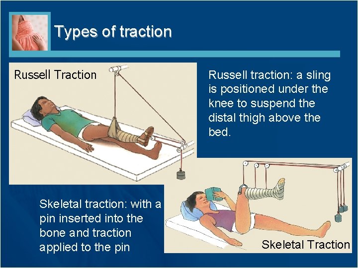 Types of traction Russell Traction Skeletal traction: with a pin inserted into the bone