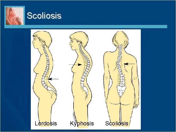 Scoliosis Lordosis Kyphosis Scoliosis 