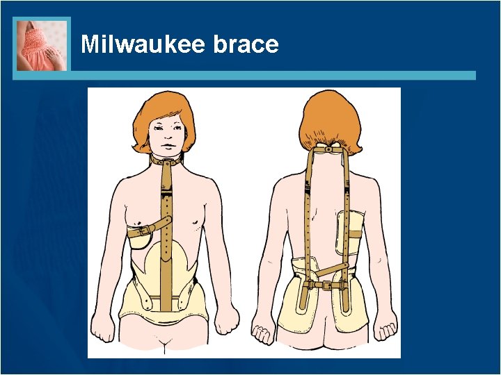 Milwaukee brace 