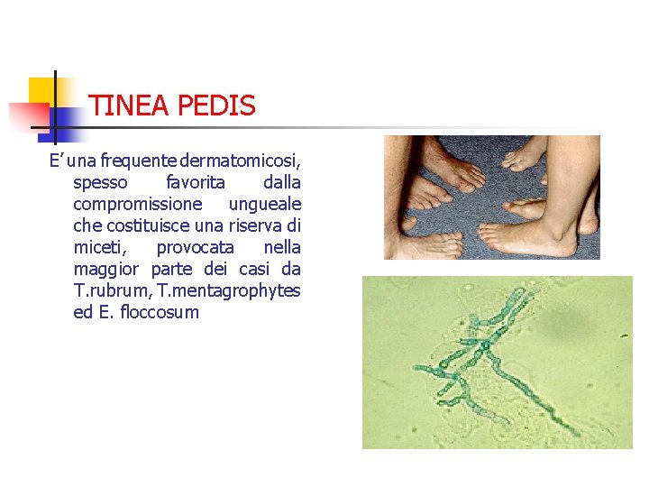 TINEA PEDIS E’ una frequente dermatomicosi, spesso favorita dalla compromissione ungueale che costituisce una