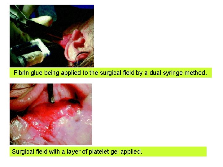 Fibrin glue being applied to the surgical field by a dual syringe method. Surgical